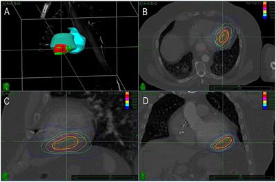 Case Report: Repeated Stereotactic Radiotherapy of Recurrent Ventricular Tachycardia: Reasons, Feasibility, and Safety